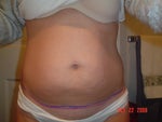 before photo and where the scar was supposed to be